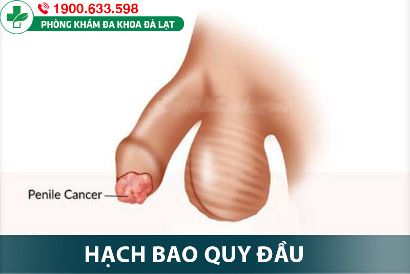 NỔI HẠCH BAO QUY ĐẦU: NGUYÊN NHÂN, DẤU HIỆU, VÀ CÁCH ĐIỀU TRỊ